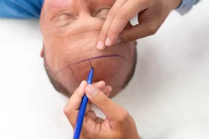 Transplante Capilar em Curitiba Cuidados no Pós-Operatório da Cirurgia de Calvície