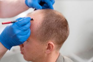 diferença entre transplante e implante de cabelos calvicie careca