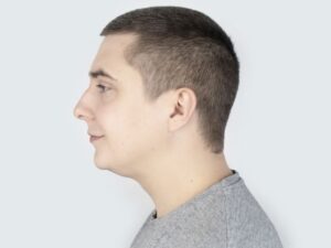Lipoaspiração de Papada Masculina em Curitiba Recupere a Harmonia Facial e a Autoestima na Clínica 40k