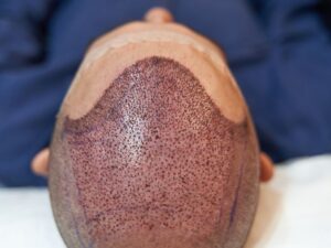 Transplante Capilar em Curitiba Recupere Seu Cabelo e Confiança na Clínica 40K
