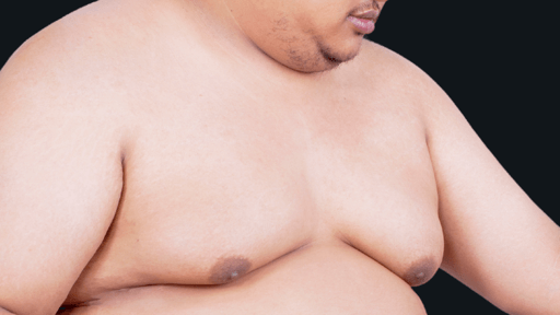 Ginecomastia em Curitiba: Recupere a Autoconfiança e a Masculinidade com Resultados Duradouros