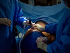 Lipo HD para Homens em Curitiba Transformação e Excelência