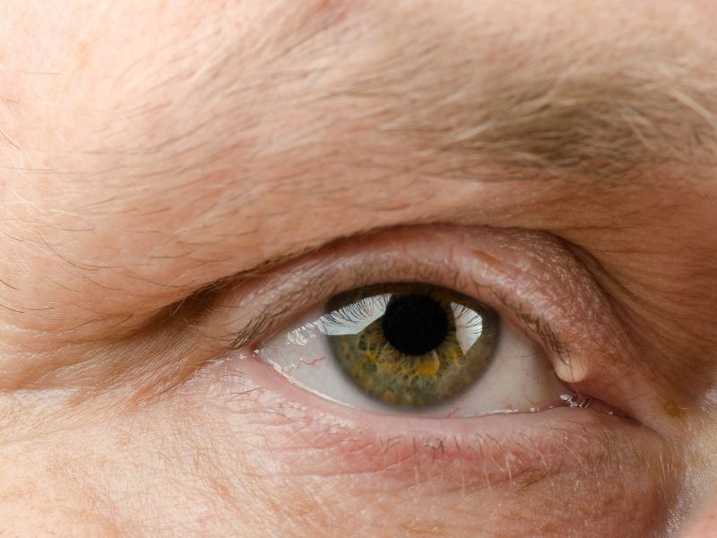 Existe Cirurgia para as Pálpebras em Curitiba