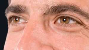 cirurgia de blefaroplastia em curitiba