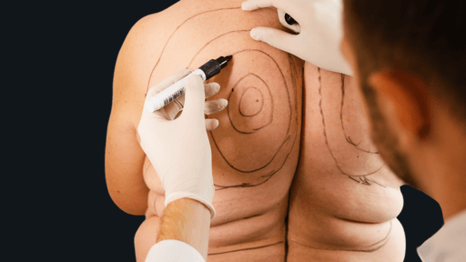 cirurgia de lipoaspiração em homem