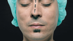 rinoplastia em curitiba