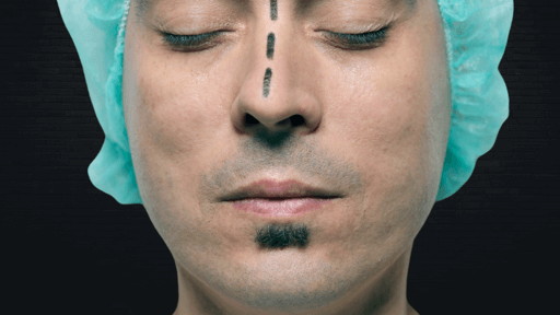 rinoplastia em curitiba