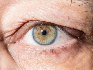 Blefaroplastia para Homem em Curitiba