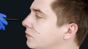 rinoplastia em curitiba